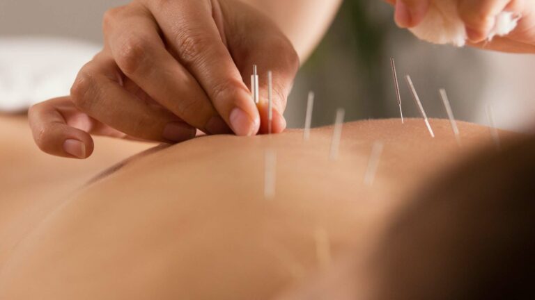 How acupuncutre works 768x432